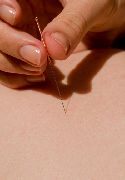 Acupuncture With Paula